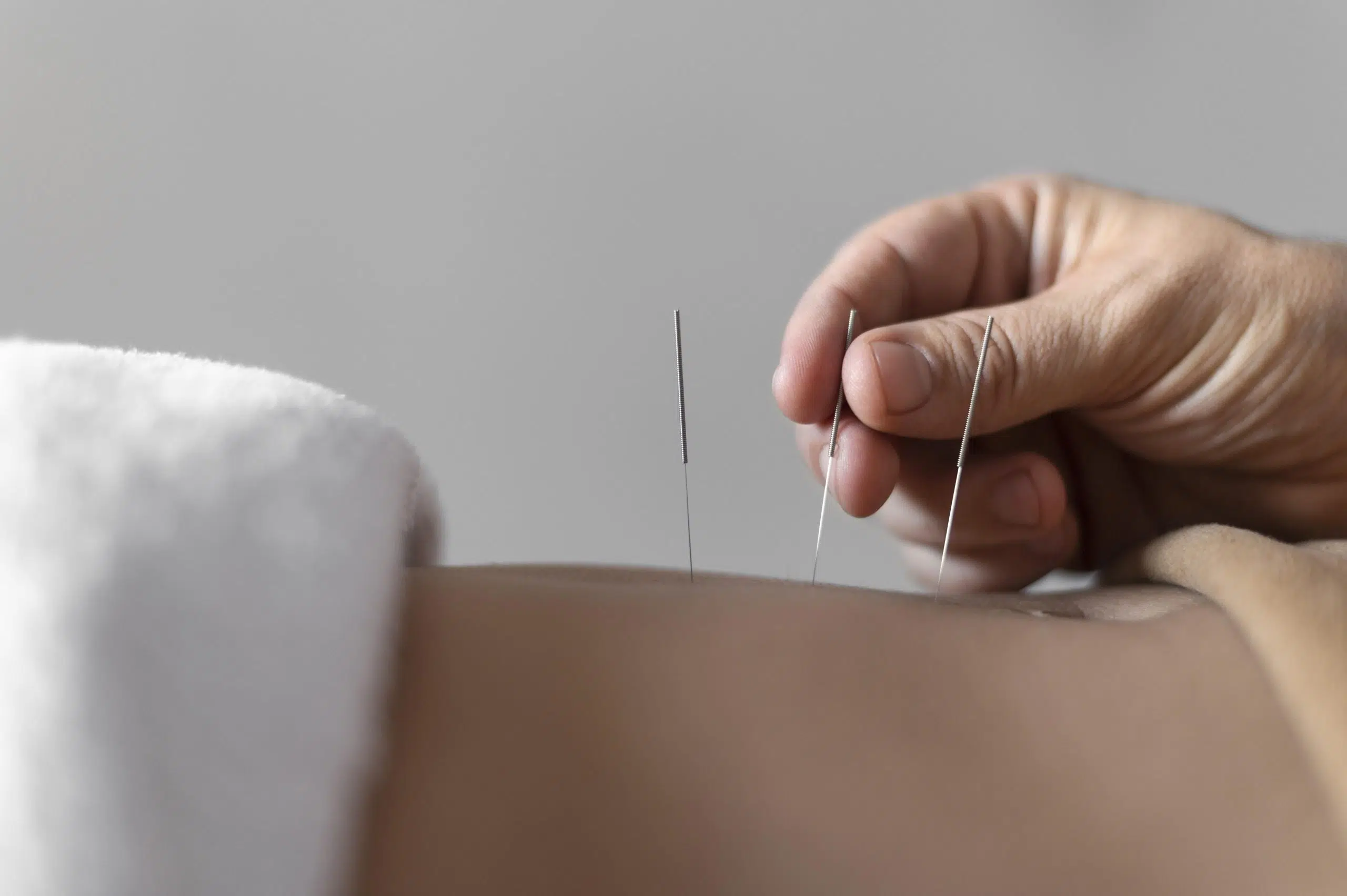 Acupuncture in Vancouver