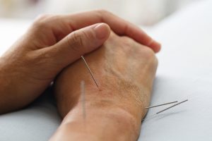 How Acupuncture Can Help with Anxiety