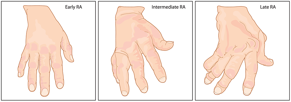 type of Rheumatoid arthritis (RA)
